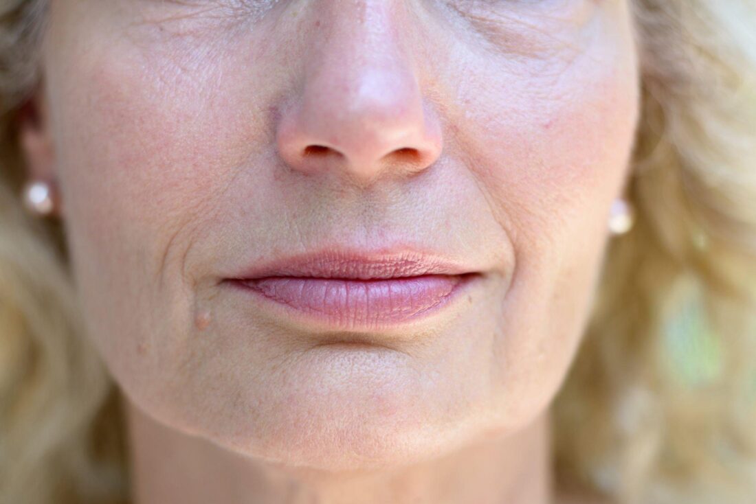 how to get rid of nose wrinkles