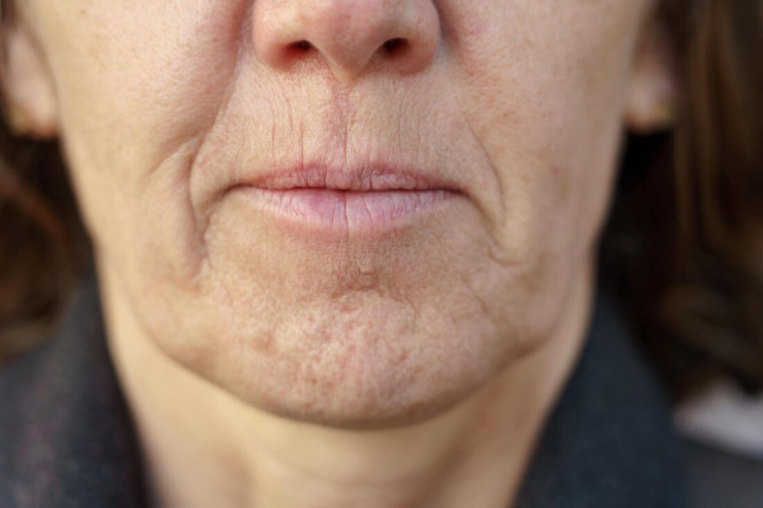 smokers mouth wrinkles