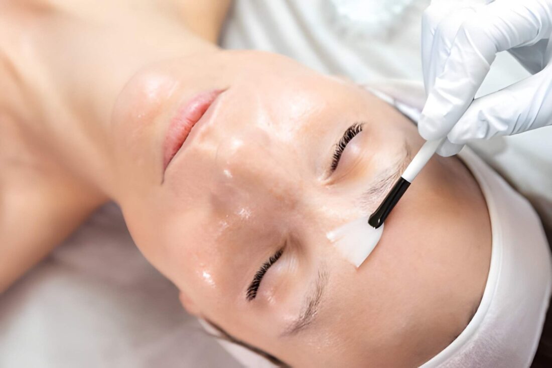 facial peel cost