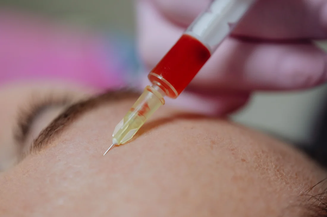 platelet-rich plasma